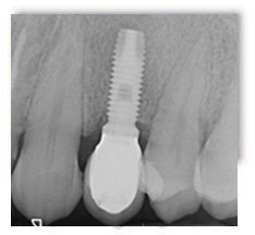 implante dental clinica dental madrid